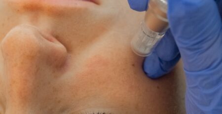 Tratamiento facial regenerativo con exosomas y PDRN en BOSA
